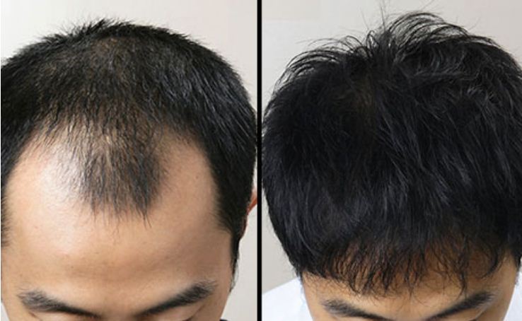 Herbal Hair Oil – Natural Way To Grow Hair Again! Price In India