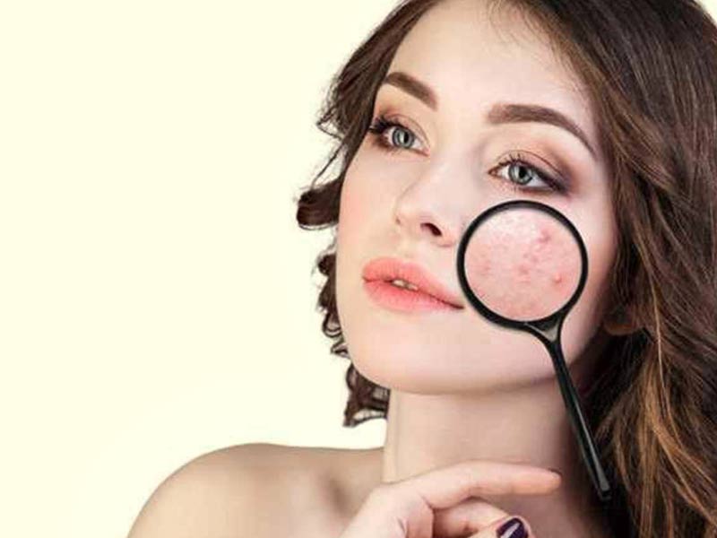 Cystic Acne – Identification, Causes, Treatment and Precautions