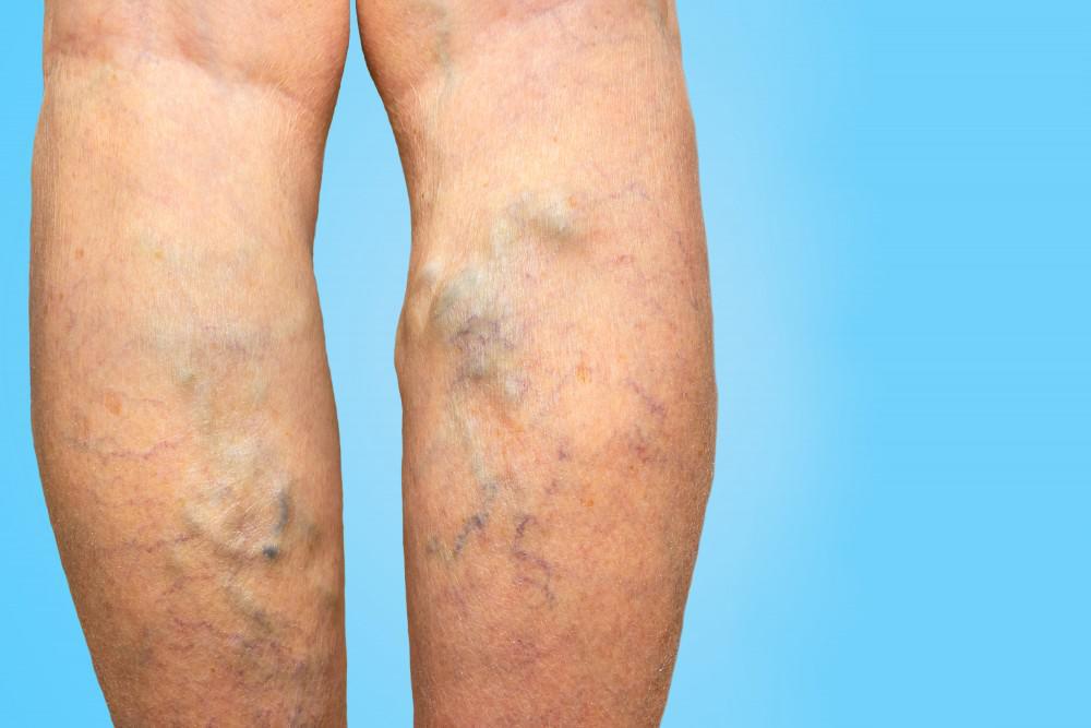 LoveIn Cream – Help Remove Varicose Veins, Update-2022, Does It Work?