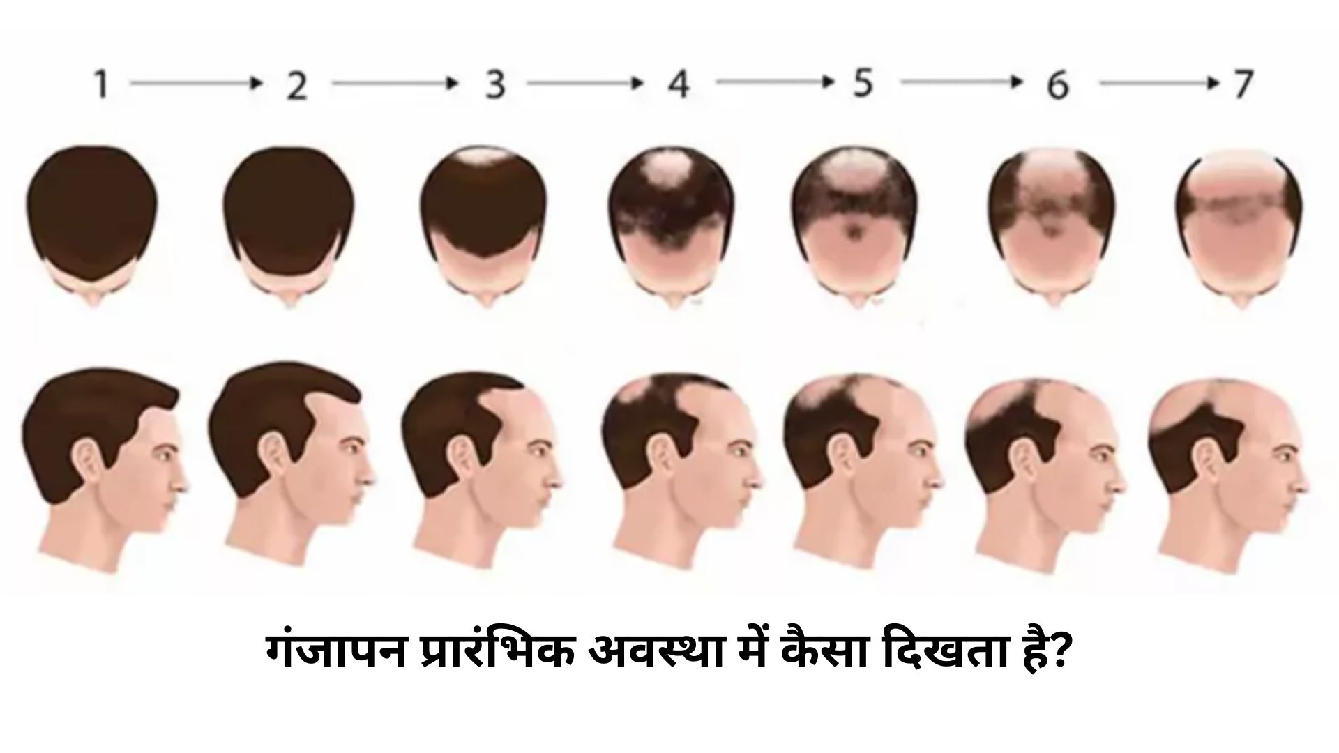 गंजापन प्रारंभिक अवस्था में कैसा दिखता है